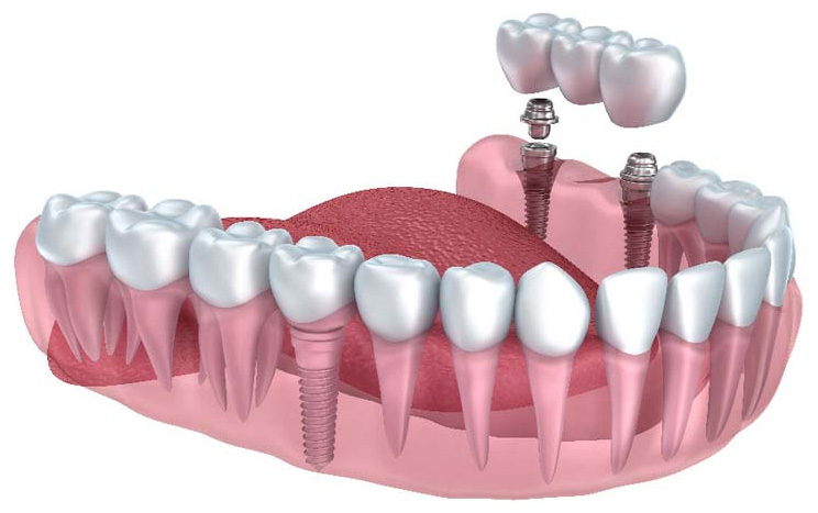 best dental implant in chandigarh